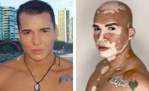 De la sombra a la luz: Este brasileño dejó de ocultar su vitiligo para triunfar como modelo